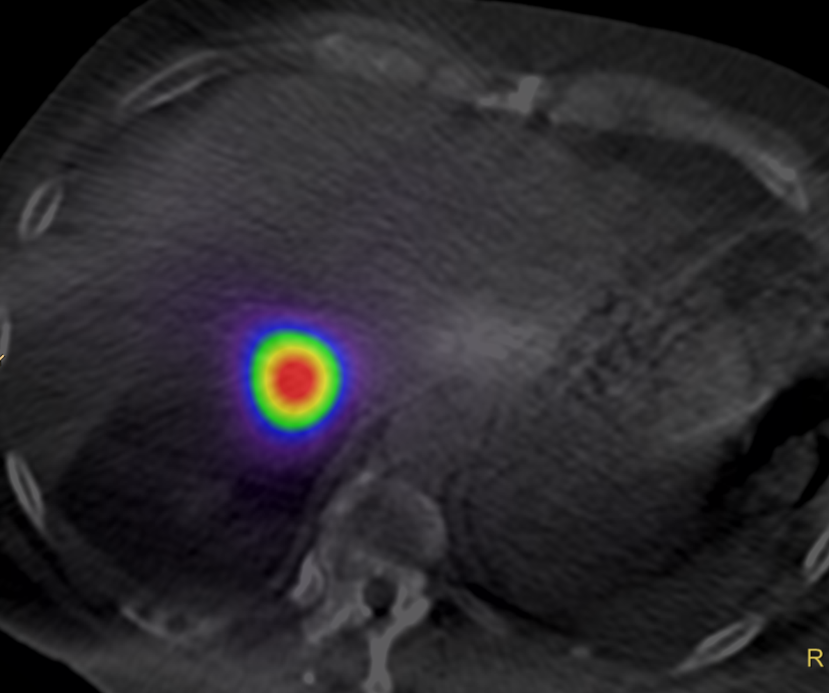 Y90 radioembolization treatment for liver tumor shown on immediate post treatment nuclear medicine imaging