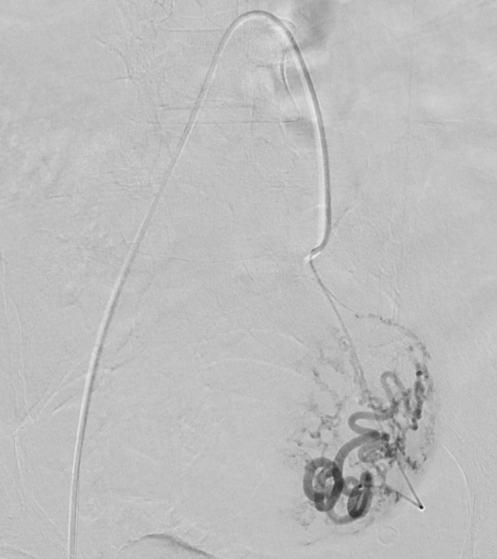 Angiographic image demonstrating uterine fibroid embolization procedure